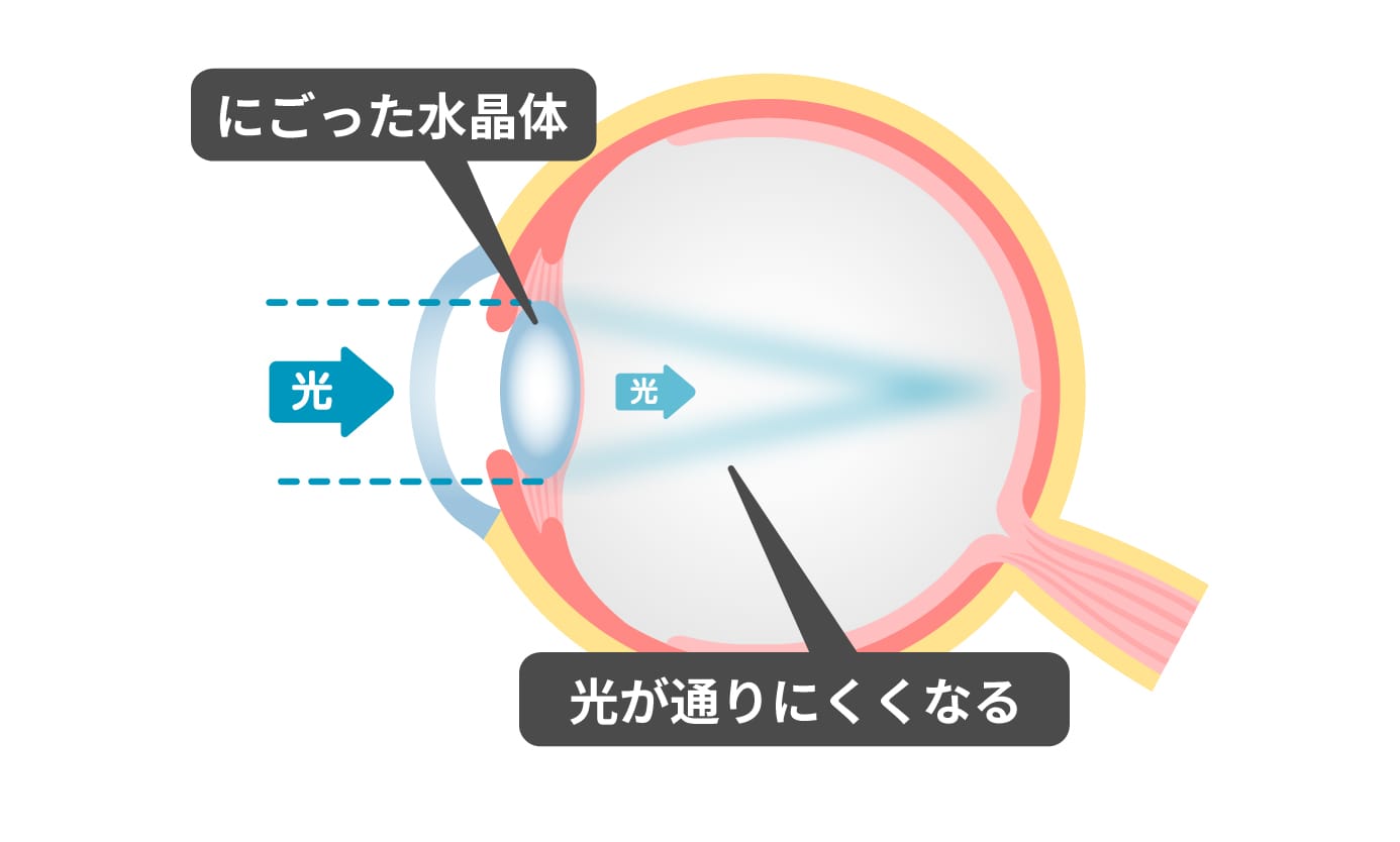 にごった水晶体では、光が通りにくくなることを示した図