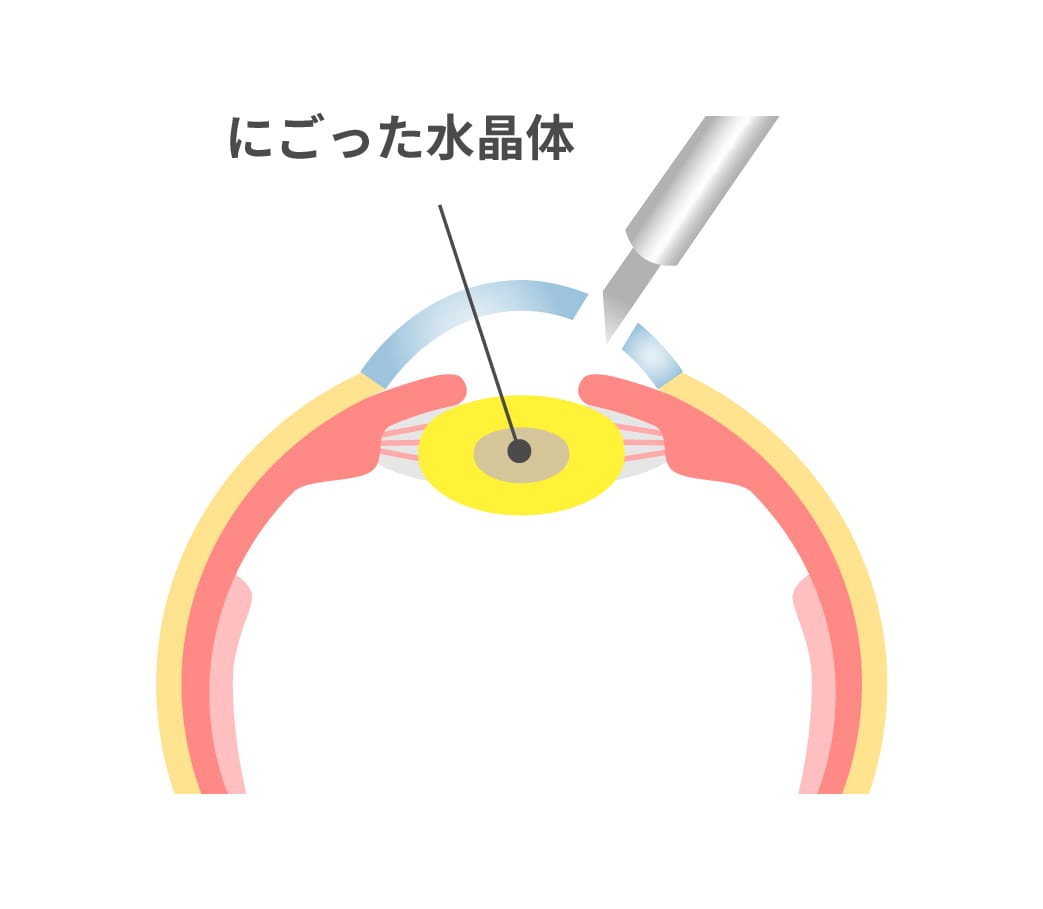 角膜切開の様子を表した眼球の断面のイラスト。にごった水晶体がある。