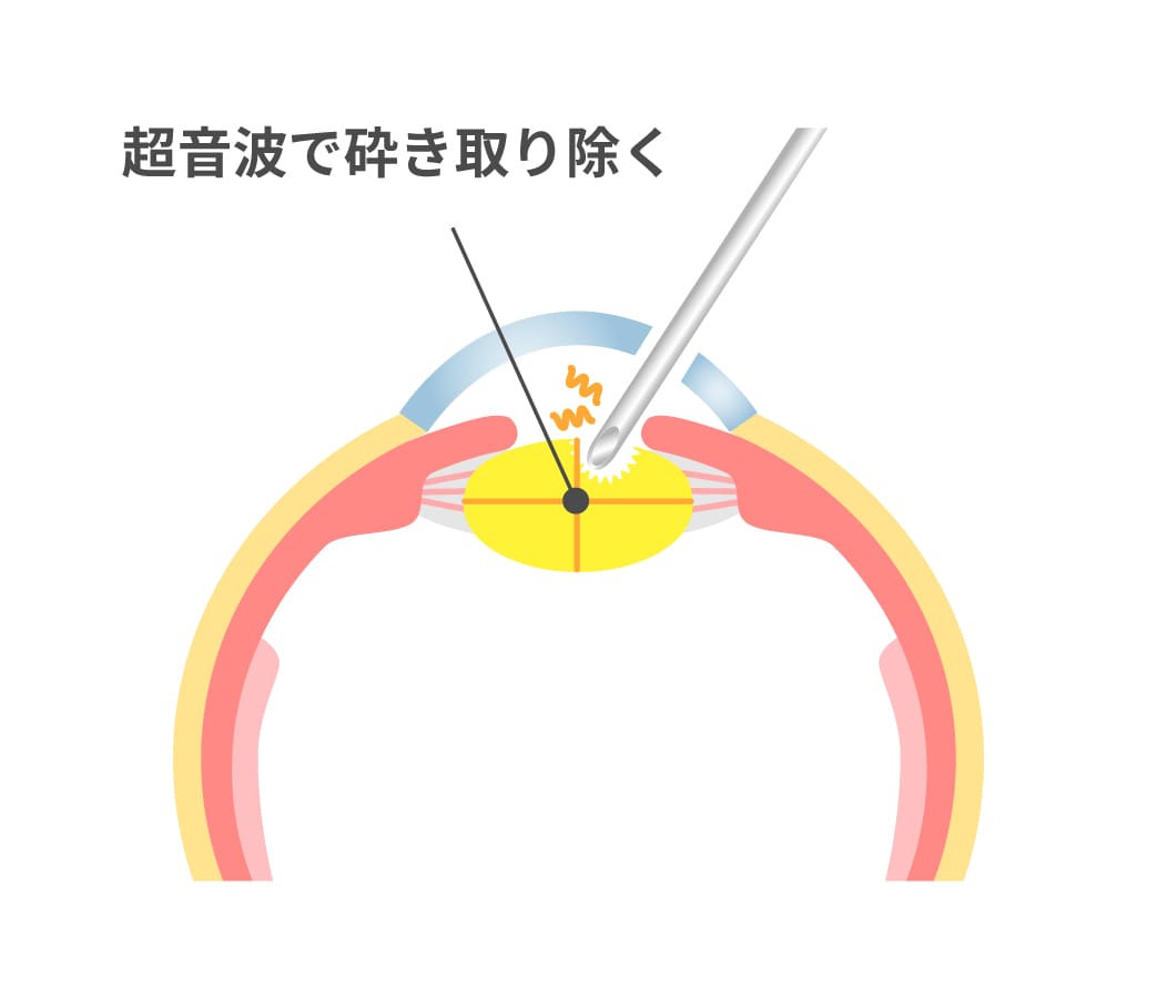 角膜切開の様子を表した眼球の断面のイラスト。水晶体を超音波で砕き、取り除く。