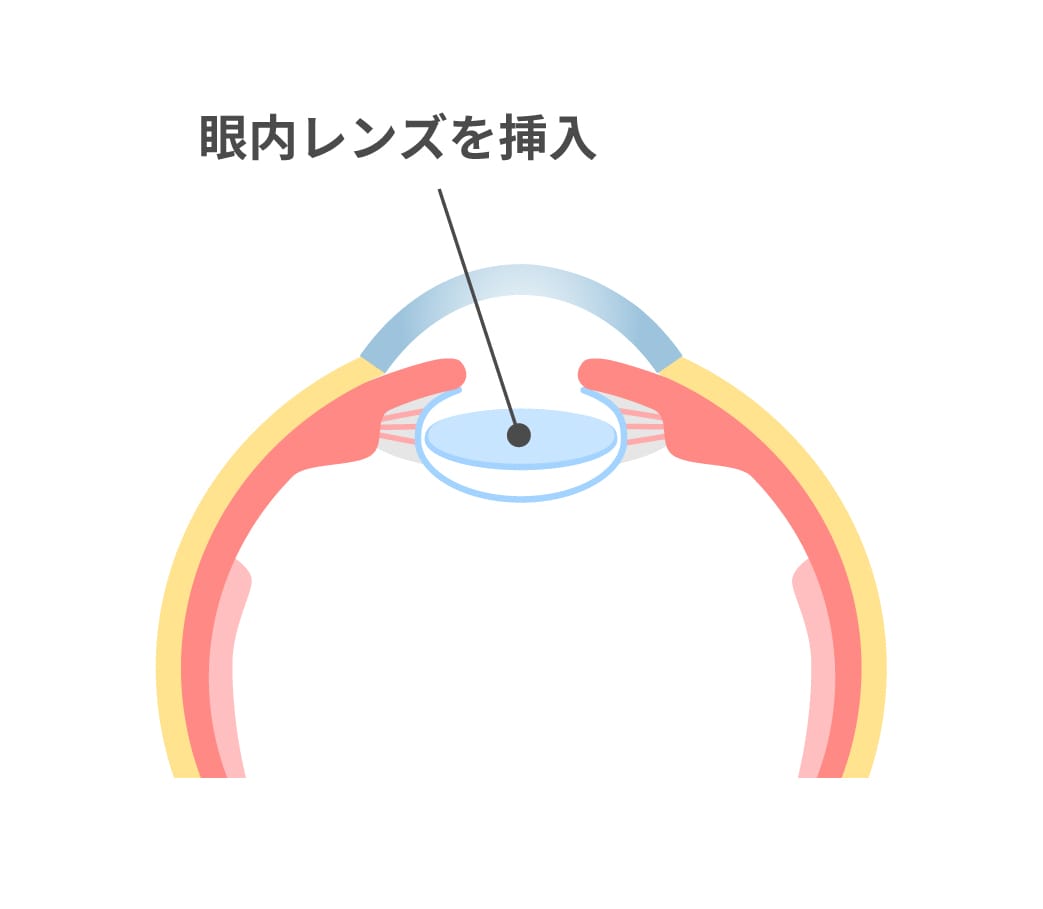 眼内レンズを挿入した状態を表した眼球の断面のイラスト